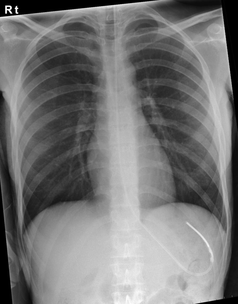 Nasogastric Tubes